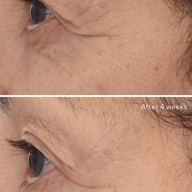 Resurgence Retinal Rescuplt Eye Lift Treatment