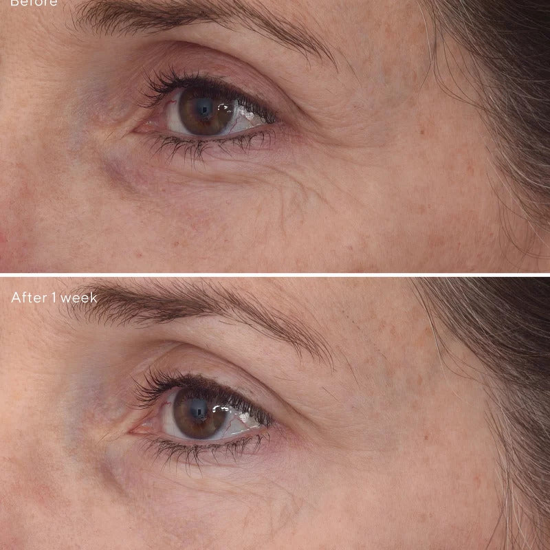 Resurgence Retinal Rescuplt Eye Lift Treatment
