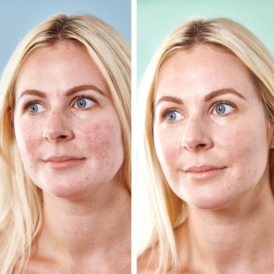 5 in 1 Anti-Redness Day Cream