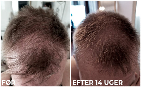 Hair Growth & Enchancing Serum + Micro Needle Roller